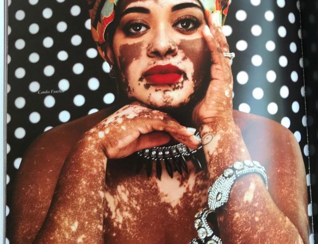 Kandice Benford Shares What Living With Vitiligo Feels Like – Episode 18