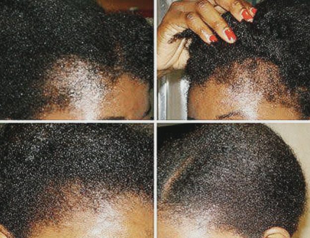 8 Ways To Grow Back Your Edges And Treat A Thinning Hairline