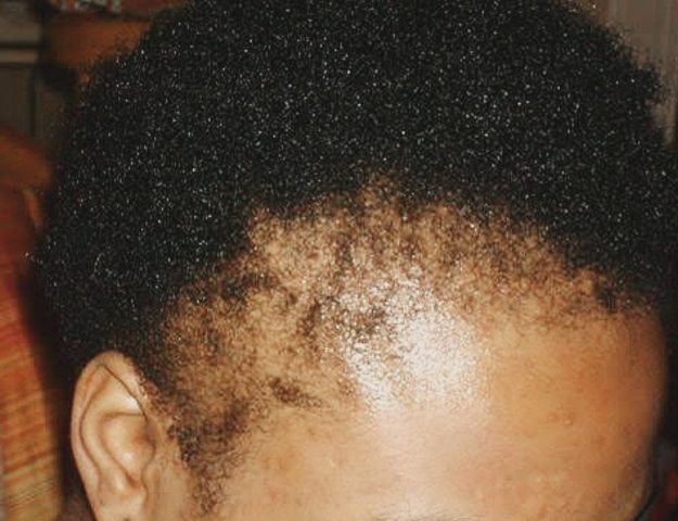 7 Reasons Black Women Are Losing Their Edges And Nape Hairs